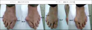 右足の外反母趾が18.3度左足の外反母趾が15.6度改善